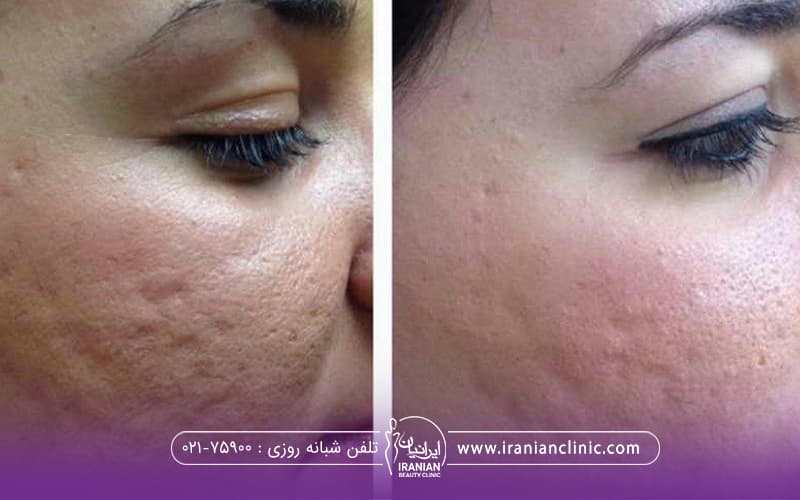 عکس قبل و بعد از مزوتراپی صورت