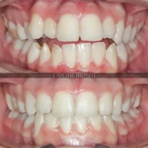 نمونه درمان ارتودنسی لینگوال