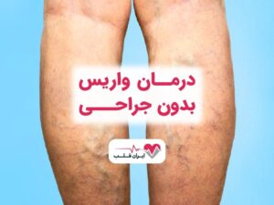 درمان واریس پا “بدون جراحی” در بهترین مرکز درمان واریس “ایران قلب”