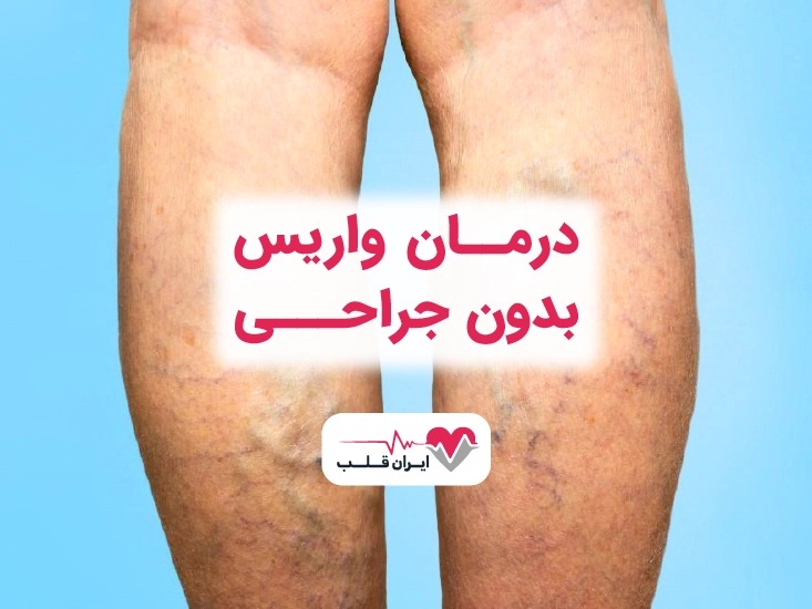 درمان واریس پا “بدون جراحی” در بهترین مرکز درمان واریس “ایران قلب”