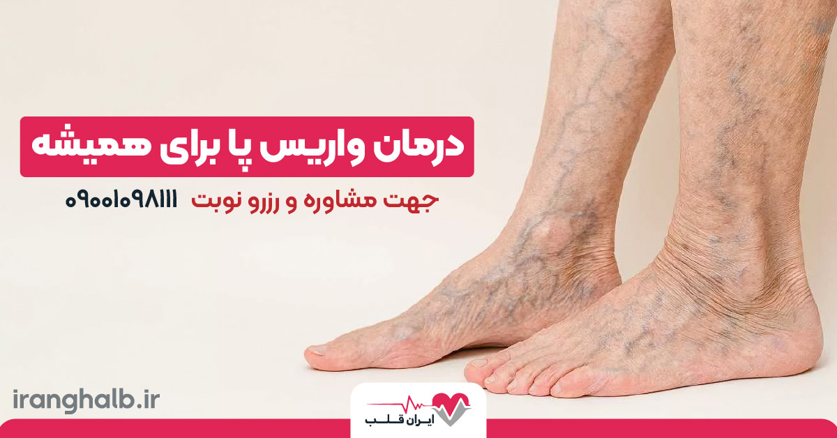 درمان واریس پا برای همیشه