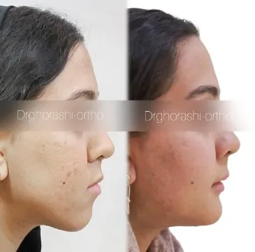 نمونه درمان ارتودنسی لینگوال شماره 3